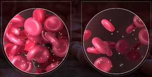 iron-deficiency-anemia-ferritin-300x152
