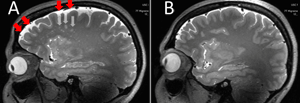 migraine-change-MRI-brain-300x103
